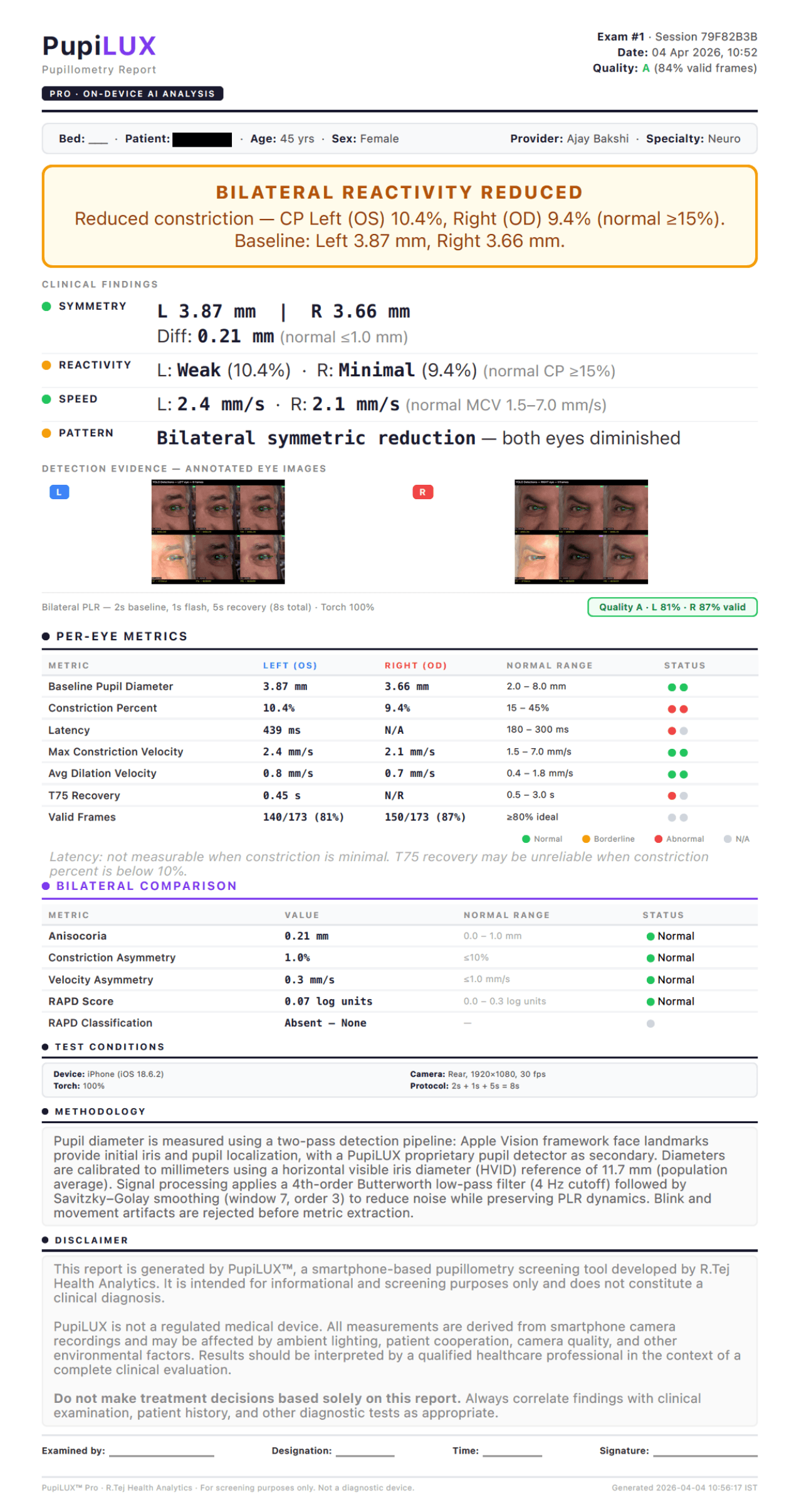 Sample PupiLUX Pro Report showing bilateral pupillograms, per-eye PLR metrics, RAPD classification, and colour-coded status indicators